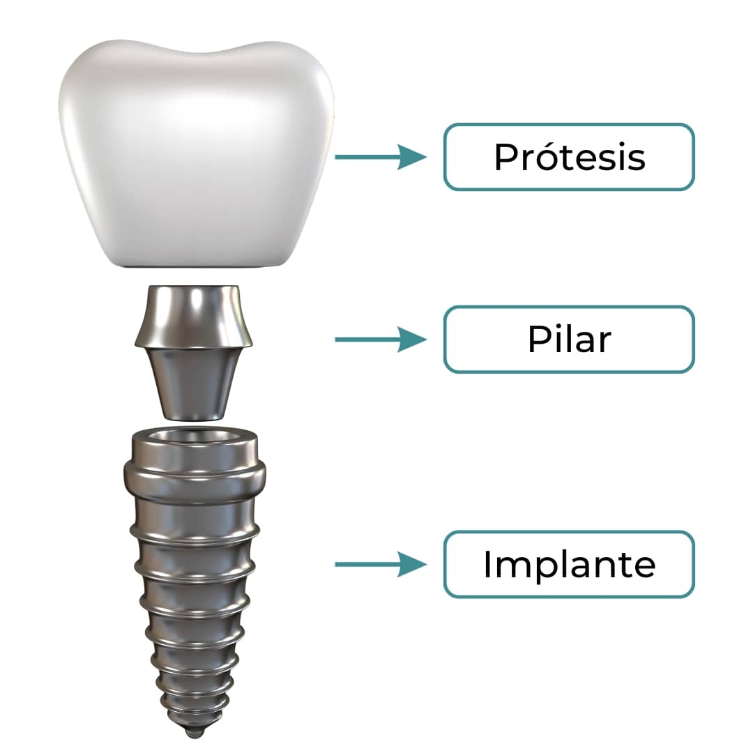 componentes implante dental